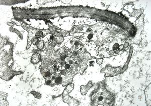 M,18y. | blood - clin. susp. leukemia - degraded Candida M,18y. | blood - clin. susp. leukemia - degraded Candida
